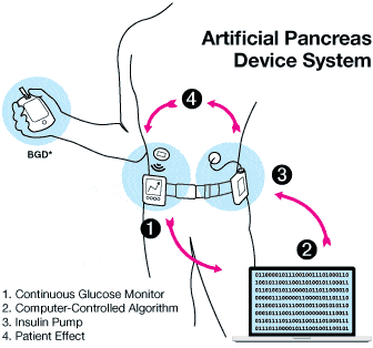 Healthcare Technology - Closed loop insulin delivery systems