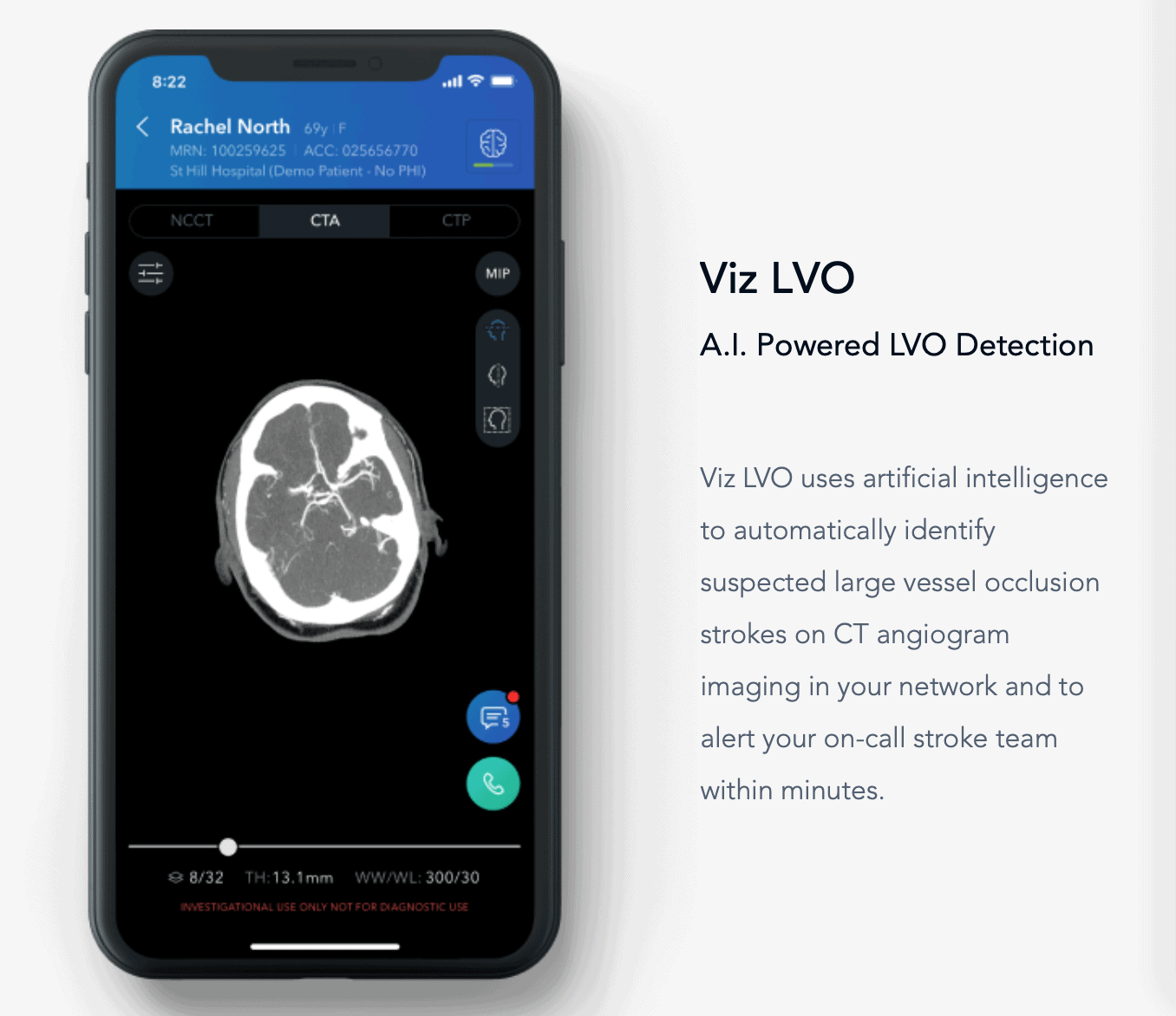 ai detect and predict stroke